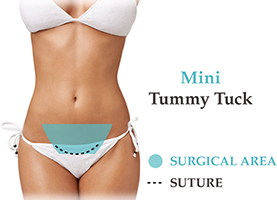 Mini-Tummy-Tuck-Tunisia